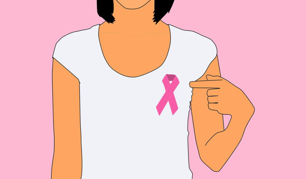 breast cancer/ lymphedema/ physical therapy